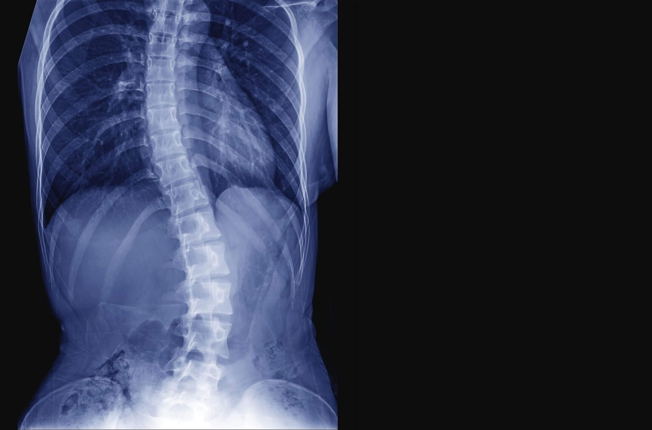 scoliosis of the spine